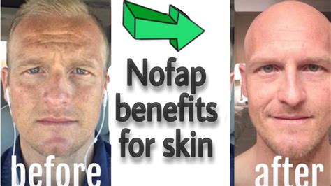 does nofap improve skin|Exploring the Benefits of Nofap for Your Body and Skin.